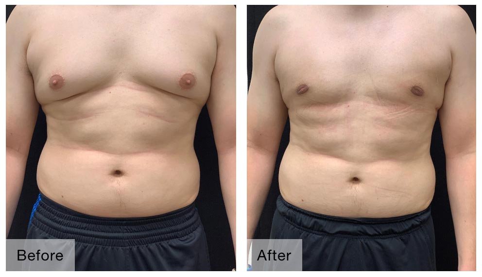 what is Gynecomastia Surgery